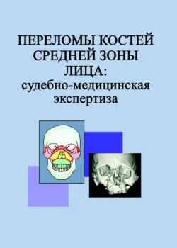 Переломы костей средней зоны лица: судебно-медицинская экспертиза, Людмила Гришенкова