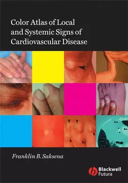 Color Atlas of Local and Systemic Manifestations of Cardiovascular Disease 