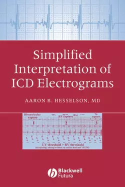 Simplified Interpretation of ICD Electrograms 