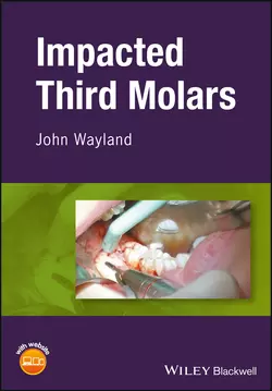 Impacted Third Molars 