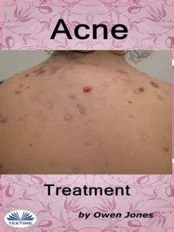 Acne Treatment, Owen Jones